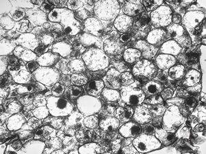 M, 14y. | pheochromocytoma